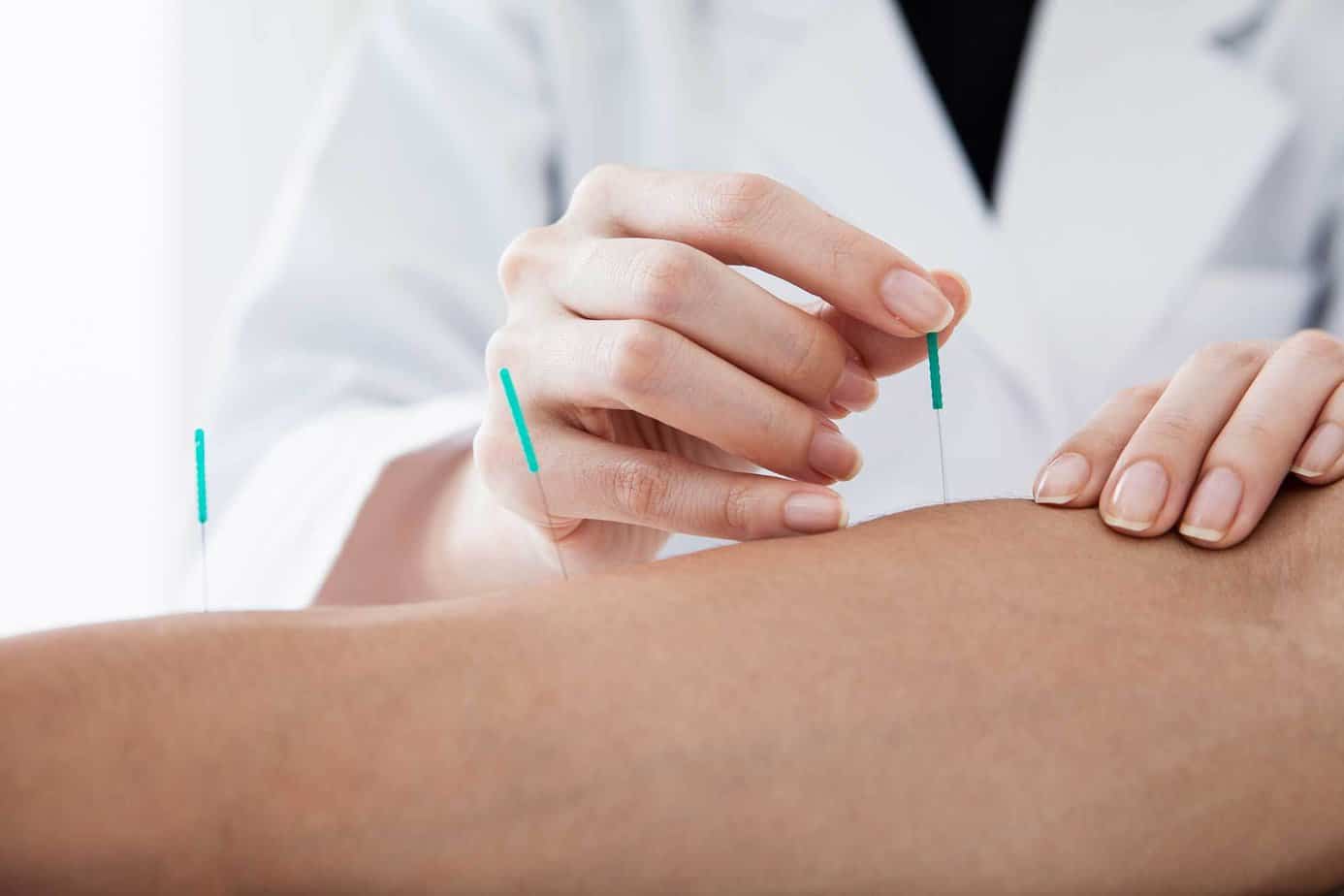 A doctor in a white coat placing acupuncture needles at Mountainside Treatment Center
