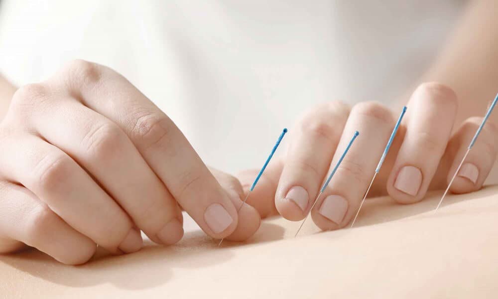 Acupuncture Therapy As Part Of Mountainside Luxury Detox Program (Bespoke)